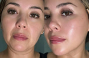 bakuchiol serum before and after wrinkle reduction