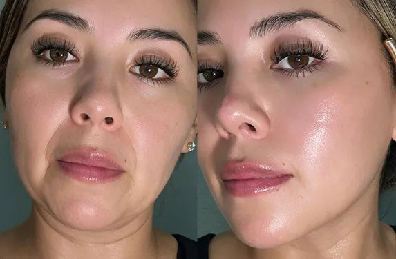 bakuchiol serum before and after wrinkle reduction