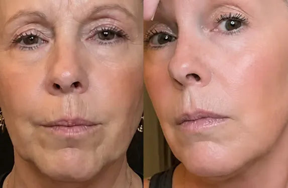 HKH plant retinol serum capsules before and after 4 weeks